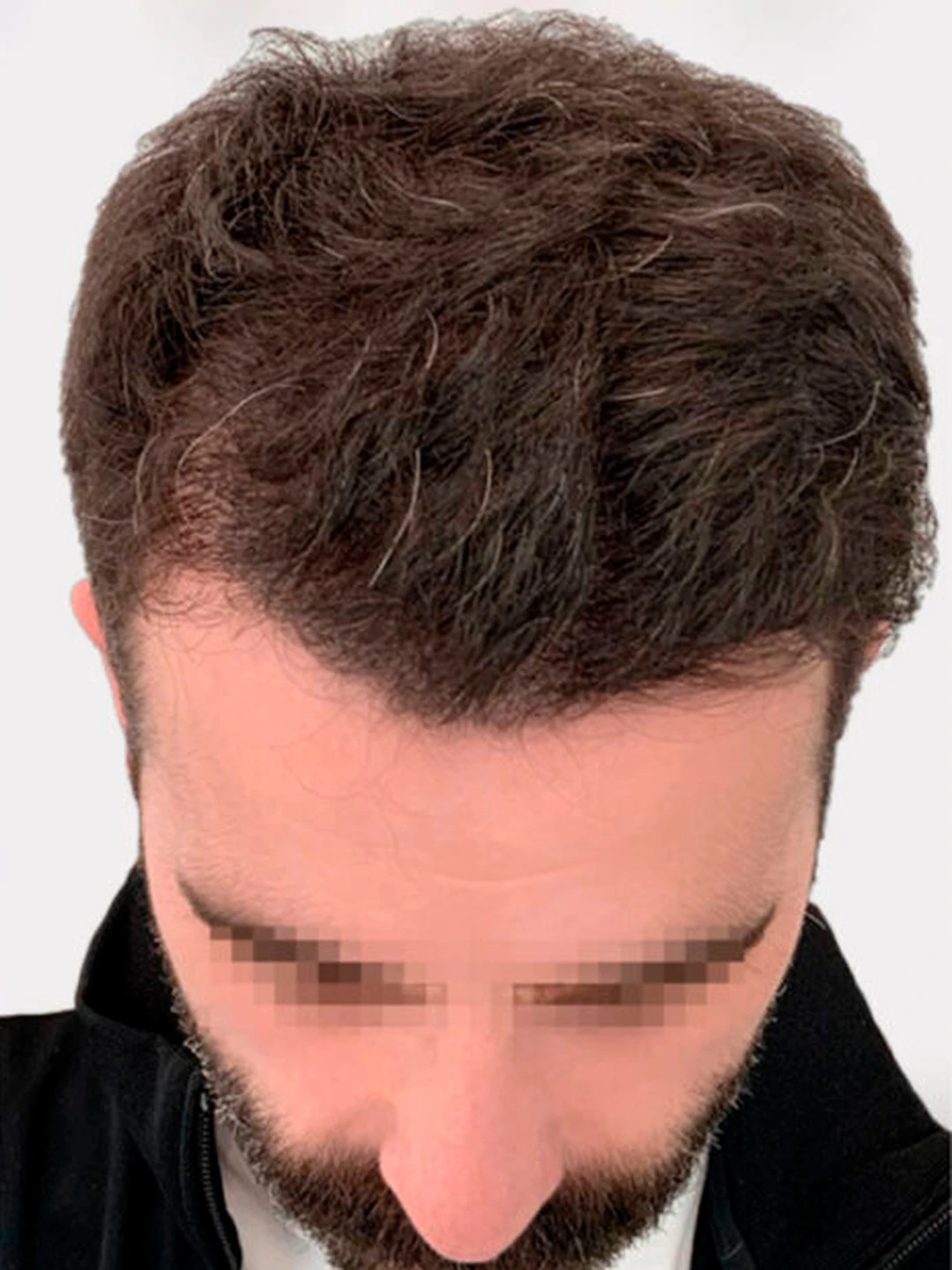 Después del trasplante capilar FUE Sapphire en la línea frontal