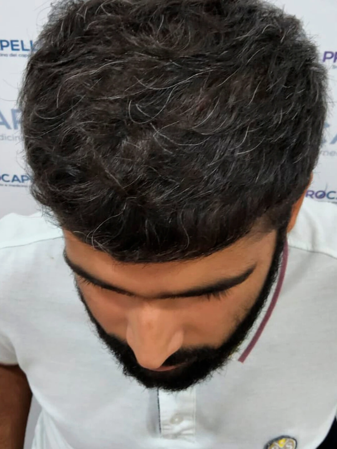 Después del procedimiento en zona superior